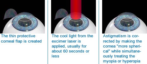 myopia hyperopia astigmatism)