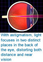 Astigmatism