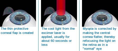 How Is Myopia Treated