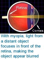 Myopia