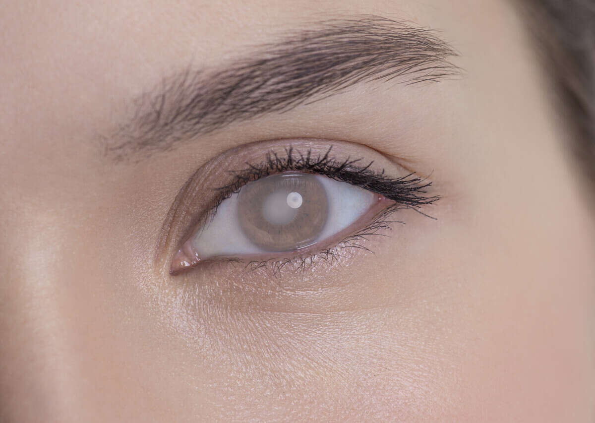 Eye of a woman with cataract and corneal opacity