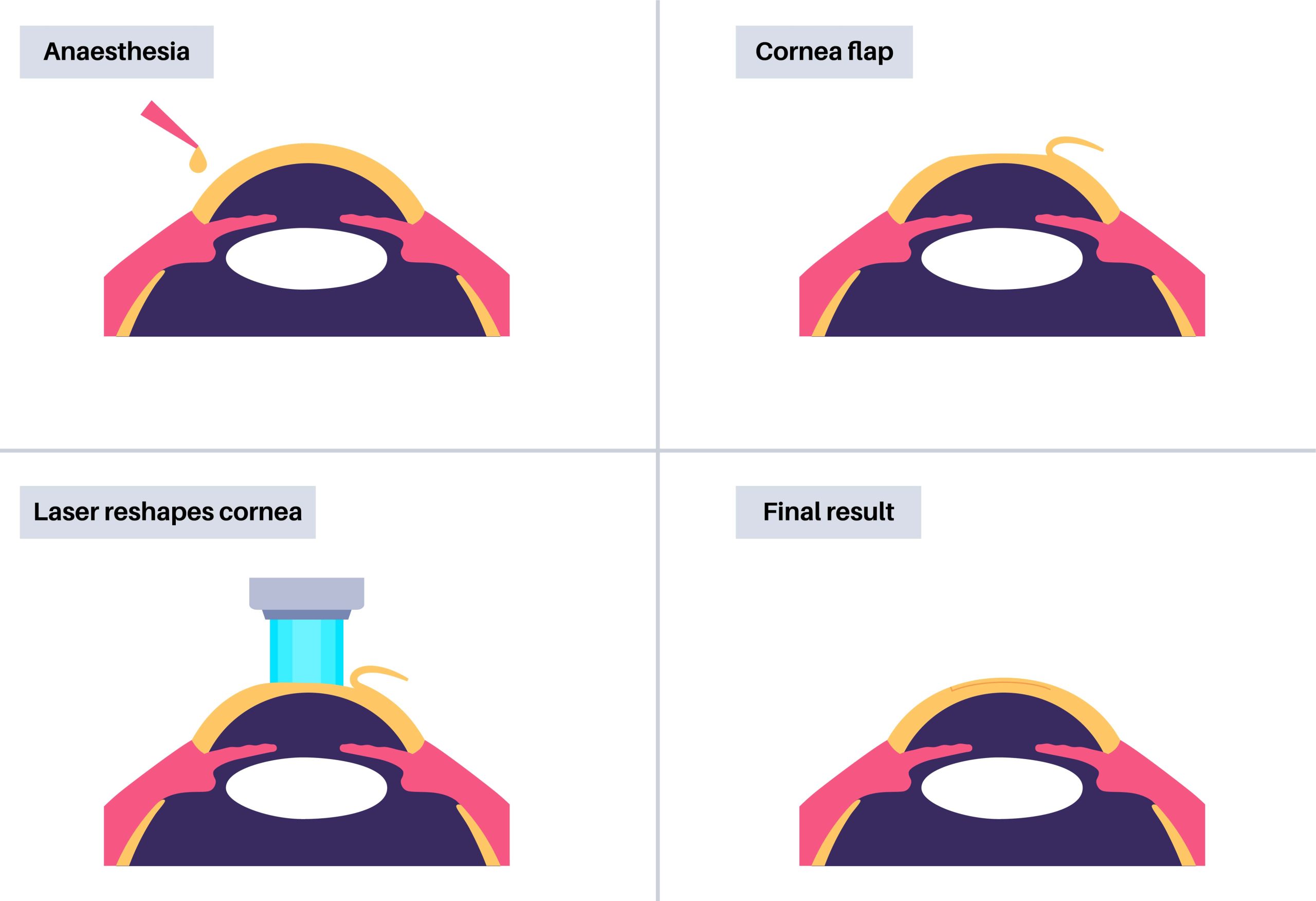 EVO ICL vs LASIK: Which Eye Surgery is Right for You