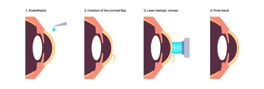 What is LASIK